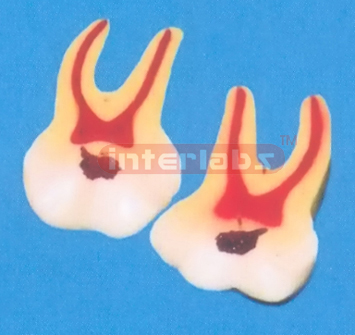 GIANT CARIES MOLAR, 2 PCS/SET